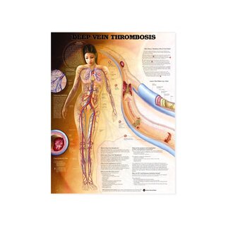 Dyb venetrombose (DVT) - planch