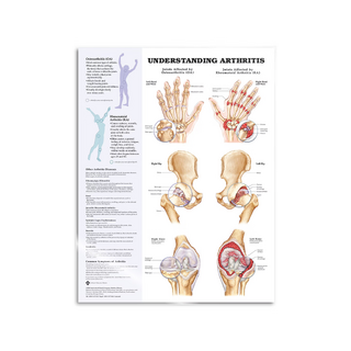 Arthritis lamineret engelsk