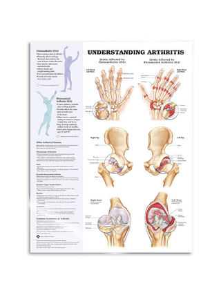 Arthritis lamineret engelsk