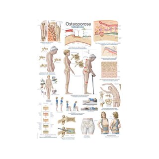 Plakat Osteoporose, Anatomisk Plakat 50x70cm