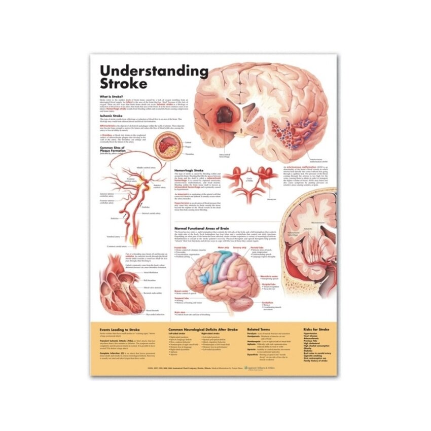 Understanding Stroke engelsk lamineret (understanding Stroke)